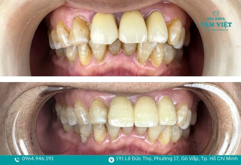 Kinh nghiệm trám răng composite ở TPHCM thẩm mỹ, an toàn 4 Trám đúng chỉ định giúp bảo tồn răng thật tối đa