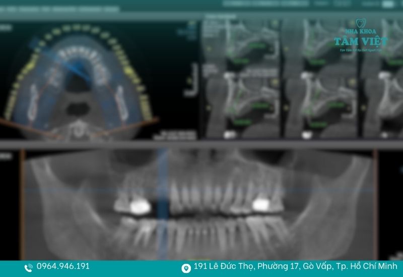 Trồng răng implant uy tín Gò Vấp không đau, hồi phục nhanh 3 Trồng răng implant chuẩn y khoa tại Nha khoa Tâm Việt