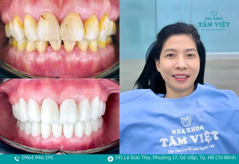 Khách hàng bọc răng sứ tại Tâm Việt