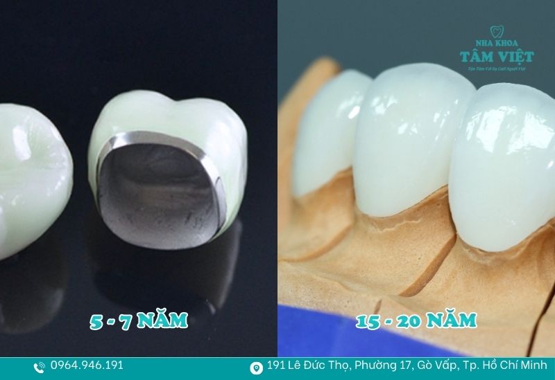Bọc răng sứ bao lâu thì phải làm lại để tránh biến chứng? 2 Tuổi thọ trung bình của các loại răng sứ hiện nay