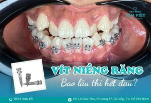 cắm vít niềng răng bao lâu hết đau