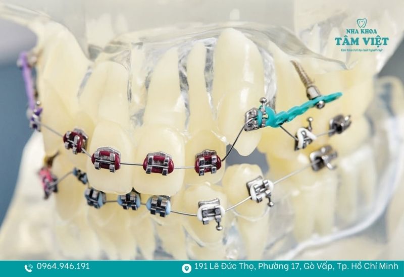 Vít như một chiếc mỏ neo cố định trên xương hàm