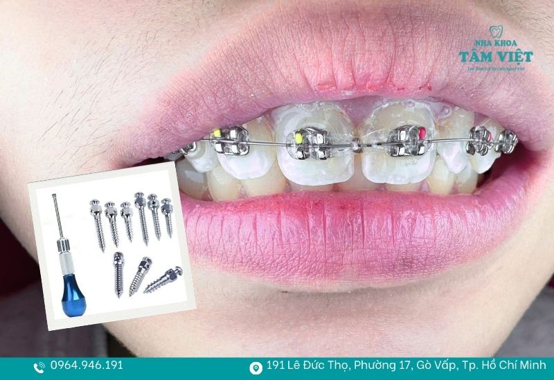 Vít sẽ được cắm từ 6 - 12 tháng