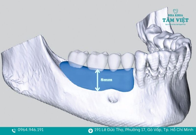 Chiều cao xương hàm ≥ 8mm