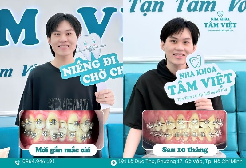 Niềng răng an toàn tại Tâm Việt