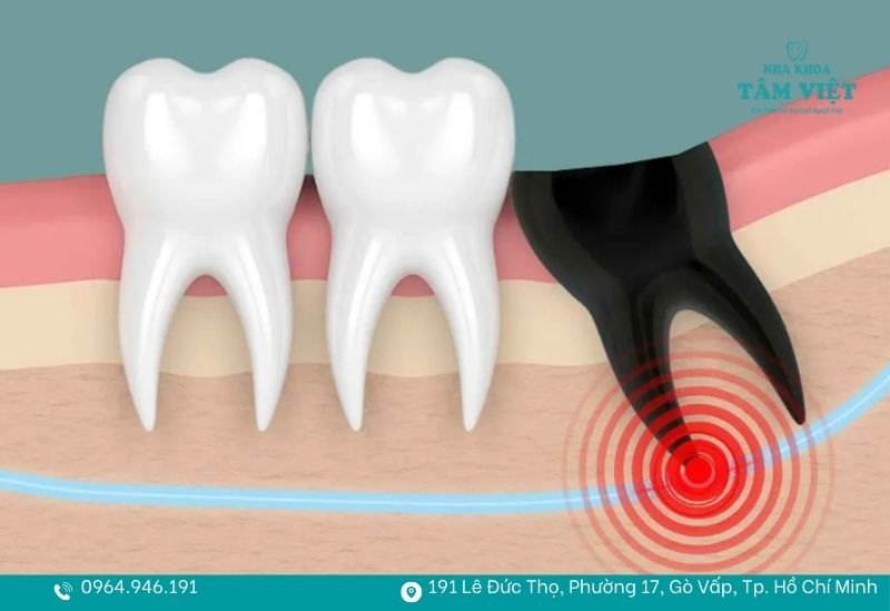 Giải đáp nhổ răng khôn có ảnh hưởng thần kinh không? 2 Ống thần kinh răng dưới nằm dưới chân răng khôn