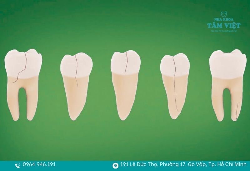 Răng bị nứt dọc phải làm sao? Có cần nhổ bỏ răng không? 2 Một đường nứt chạy dài từ mặt nhai hướng xuống