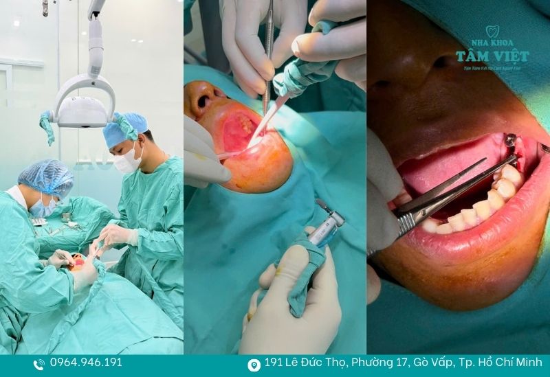 Răng bị nứt dọc phải làm sao? Có cần nhổ bỏ răng không? 5 Thăm khám sớm để xử lý kịp thời