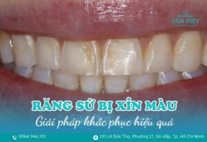 răng sứ bị xỉn màu