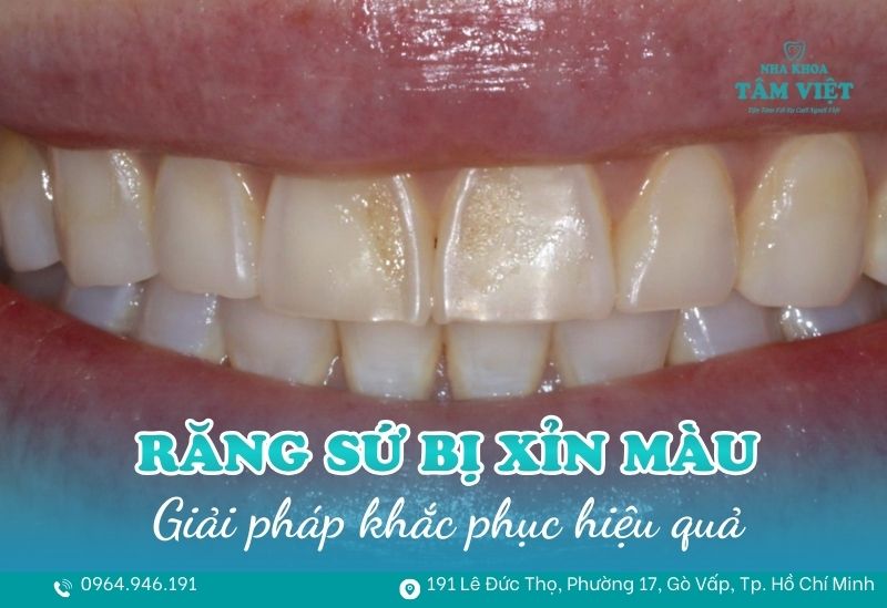 Làm gì khi răng sứ bị xỉn màu và trở nên kém thẩm mỹ? 1 răng sứ bị xỉn màu