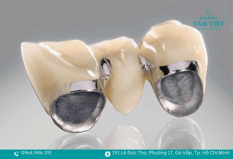 Làm gì khi răng sứ bị xỉn màu và trở nên kém thẩm mỹ? 3 Răng sứ kim loại có thể bị oxy hoá