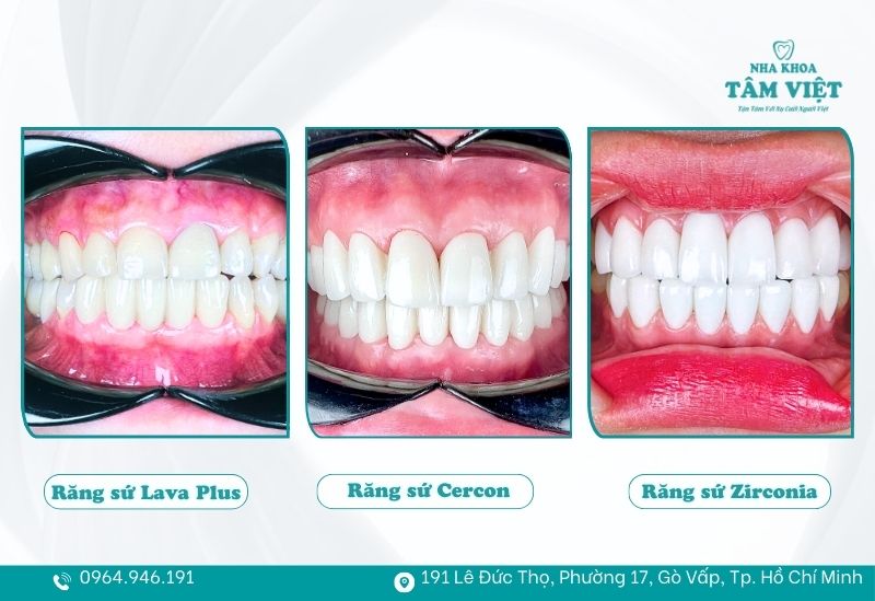 Làm gì khi răng sứ bị xỉn màu và trở nên kém thẩm mỹ? 5 Bọc lại răng sứ thẩm mỹ