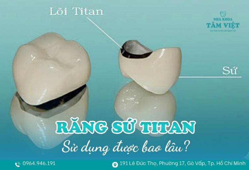 răng sứ Titan sử dụng được bao lâu