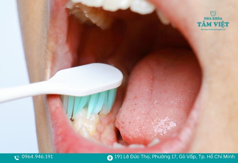 Chải răng ít nhất 2 lần/ngày giúp răng sứ Titan sử dụng lâu hơn