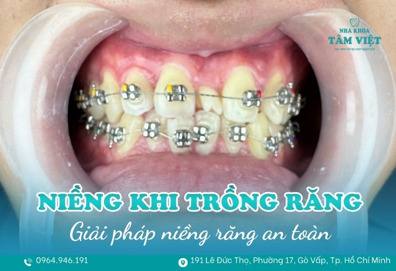 trồng răng có niềng được không