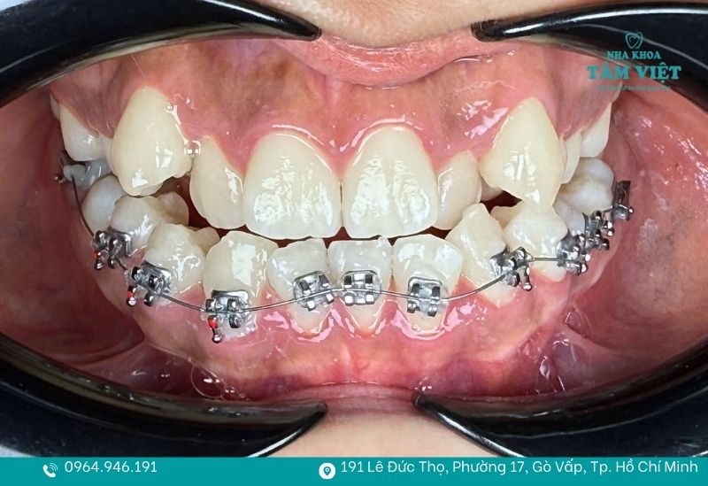 Niềng răng khi đã trồng răng giả hoàn toàn khả thi