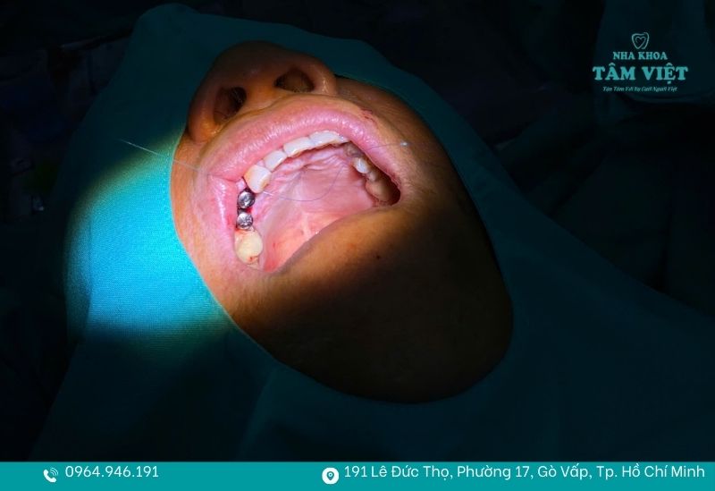 Trụ implant sẽ không thể di chuyển