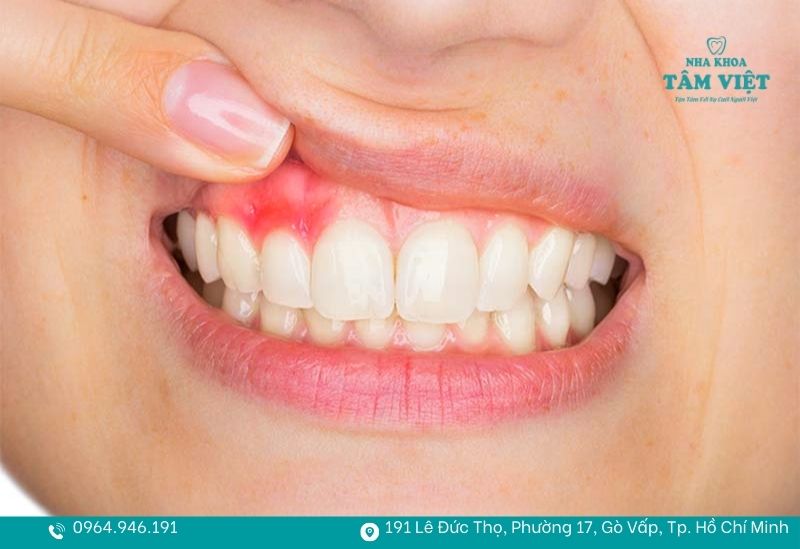 Giải đáp viêm nha chu có trồng răng implant được không 2 Viêm nha chu do vi khuẩn tích tụ lâu ngày dưới nướu