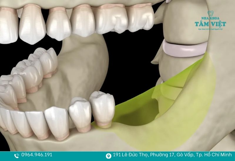 Giải đáp viêm nha chu có trồng răng implant được không 3 Viêm nha chu có thể gây ra tiêu xương