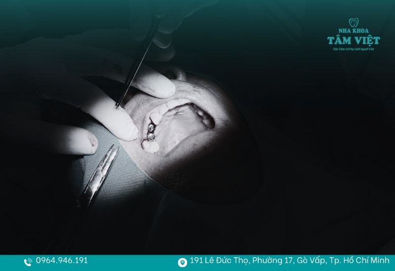 Giải đáp viêm nha chu có trồng răng implant được không 4 Trồng răng implant vẫn có thể đạt kết quả tốt