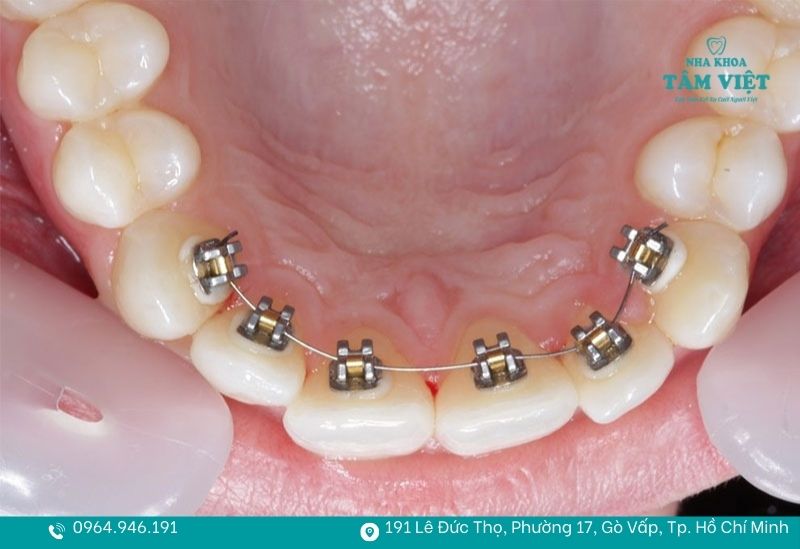 15 tuổi niềng răng bao lâu để răng đều và ổn định? 2 15 tuổi niềng răng bao lâu?