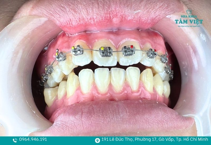 15 tuổi niềng răng bao lâu để răng đều và ổn định? 5 Niềng răng mắc cài kim loại là phương pháp phổ biến