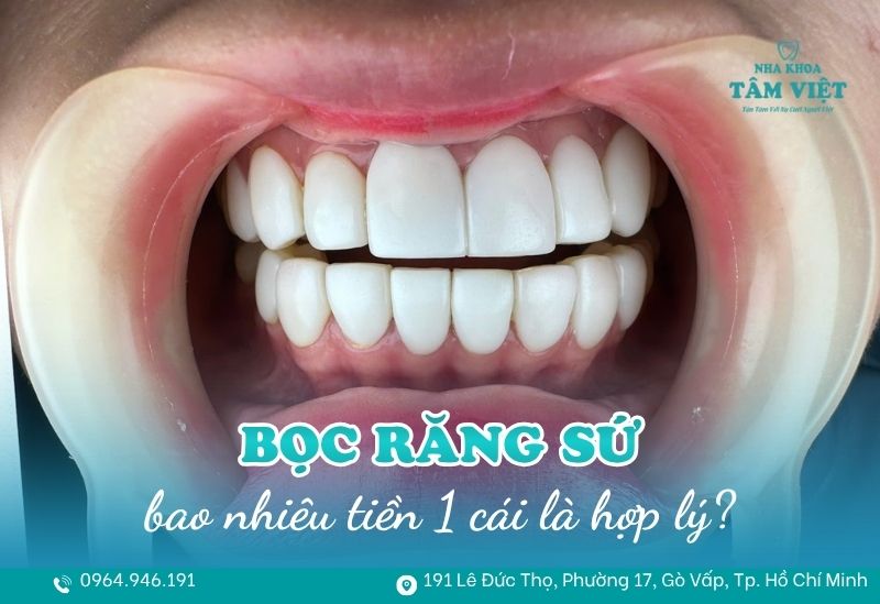 Bọc răng sứ bao nhiêu tiền 1 cái là hợp lý? 1 bọc răng sứ bao nhiêu tiền 1 cái