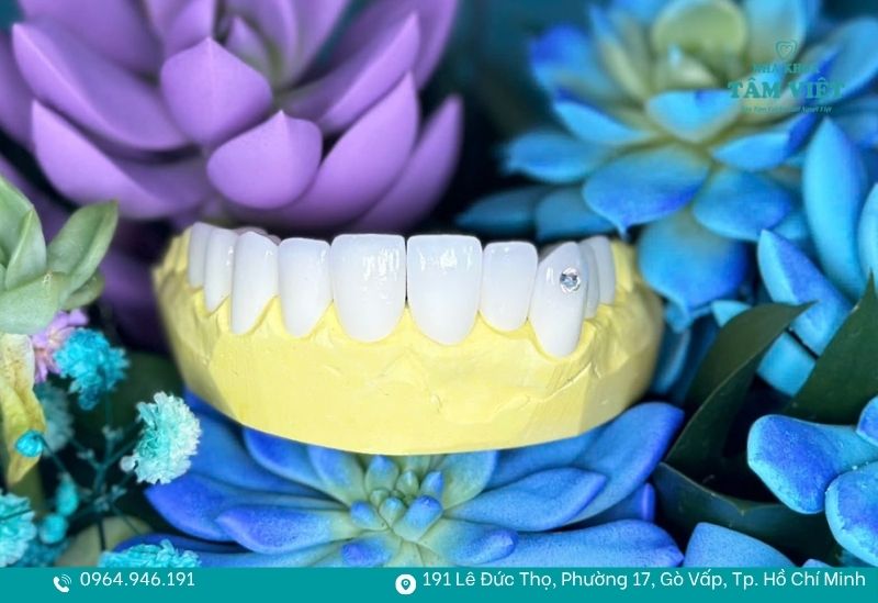 Bọc răng sứ bao nhiêu tiền 1 cái là hợp lý? 4 Loại răng sứ bạn lựa chọn sẽ ảnh hưởng đến chi phí làm răng