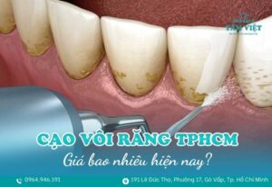 cạo vôi răng không đau TPHCM