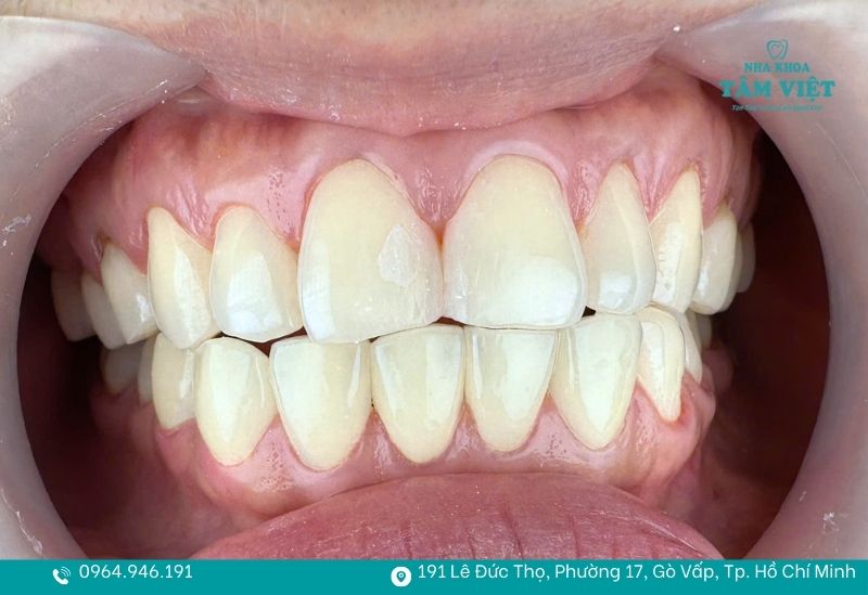 Mặt dán sứ siêu mỏng