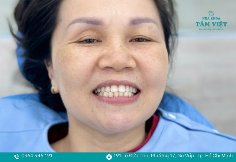 Khách hàng dán sứ Veneer tại Tâm Việt