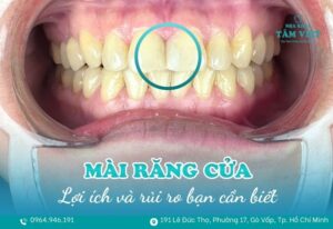 có nên mài răng cửa không