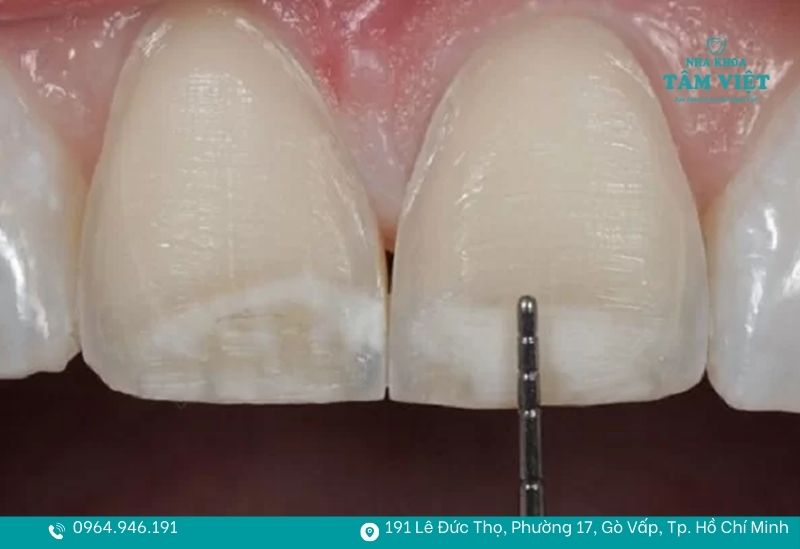 Có nên mài răng cửa không? Lợi ích và rủi ro bạn cần biết 2 Mài răng cửa là gì?