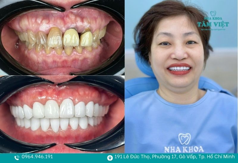 Bọc răng sứ cần chú ý vào chất lượng