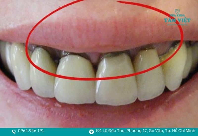 Biến chứng đen viền nướu