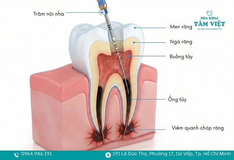 Biến chứng viêm tủy răng