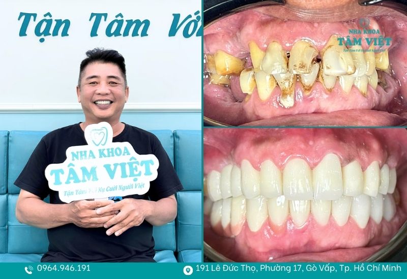 Khách hàng bọc sứ tại Tâm Việt