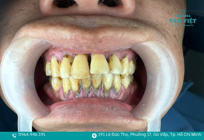 Khi nào nên bọc răng sứ để đảm bảo tính thẩm mỹ và an toàn? 2 Khi răng bị nhiễm màu thì bạn nên bọc răng sứ