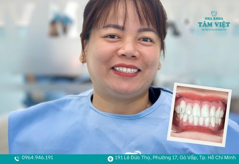 Dịch vụ bọc sứ thẩm mỹ