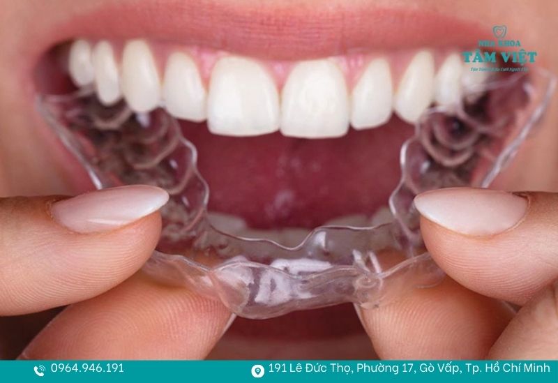 Sử dụng khay niềng trong suốt có thể tháo lắp