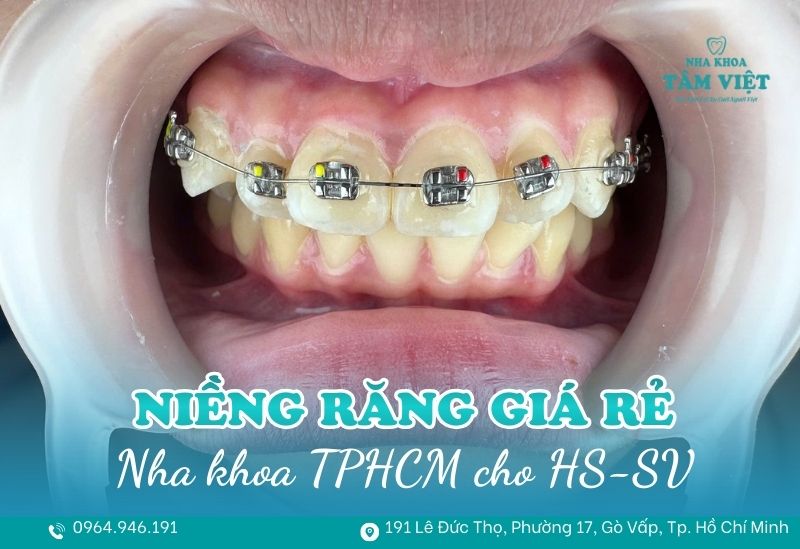 nha khoa niềng răng giá rẻ cho học sinh TPHCM