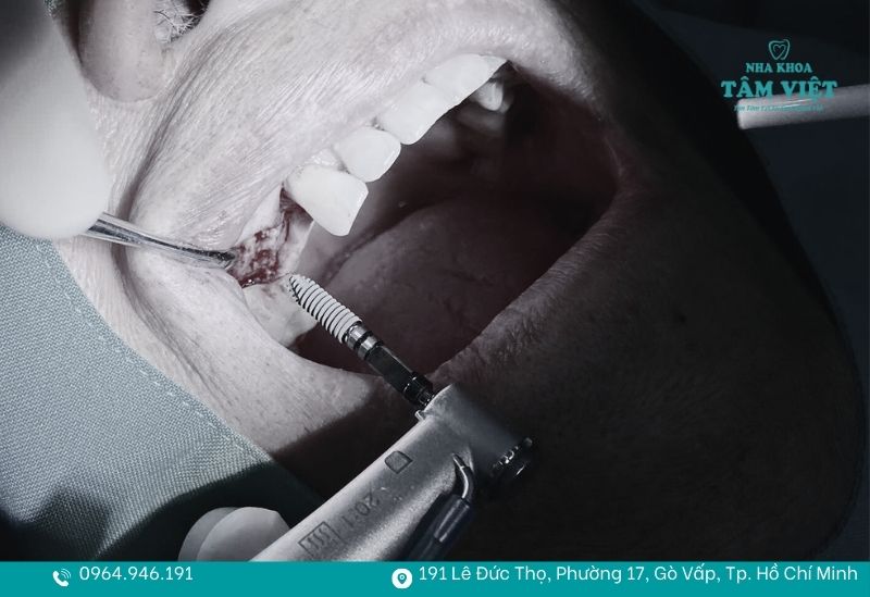 Giải đáp sau nhổ răng bao lâu thì cấy implant là tốt nhất? 2 Cấy implant tức thì ngay sau khi nhổ răng