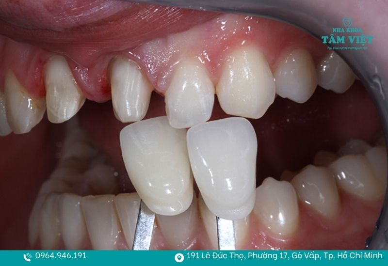 Răng sứ bị hôi miệng phải làm sao để hết mùi khó chịu? 3 Tháo bỏ răng sứ cũ để kiểm tra tình trạng cùi răng