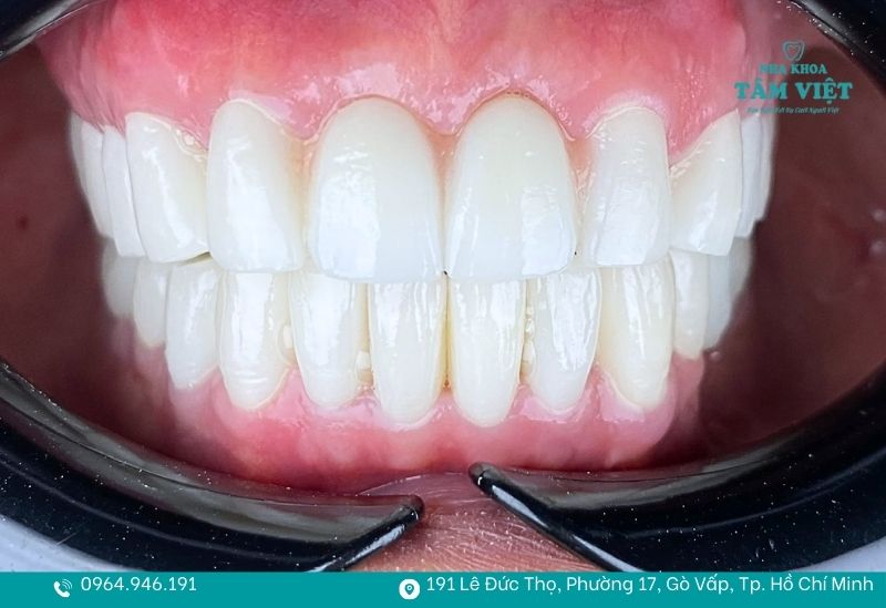 Răng sứ bị hôi miệng phải làm sao để hết mùi khó chịu? 5 Sử dụng vật liệu răng sứ chất lượng cao