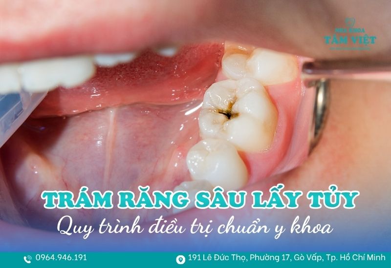 trám răng sâu có cần lấy tủy