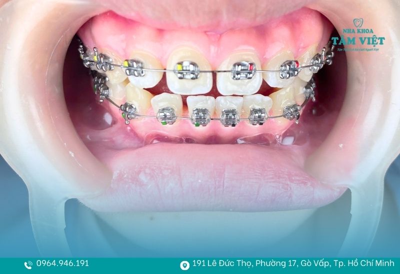 Vai trò của hàm duy trì sau khi niềng quan trọng thế nào? 4 Bảo vệ kết quả niềng răng trọn đời