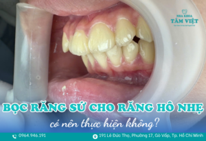 bọc răng sứ cho răng hô nhẹ