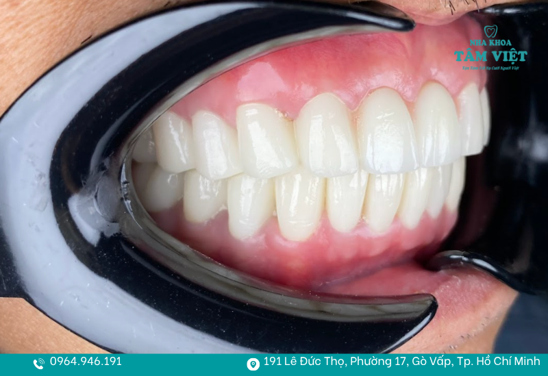 Răng hô nhẹ có mức độ lệch không quá lớn 