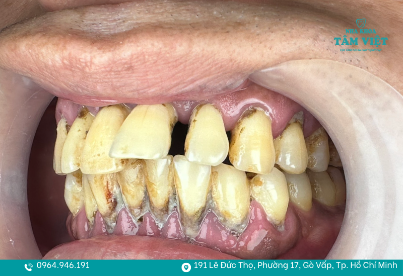 Người bị hô nhẹ 1 - 2 răng có thể thực hiện bọc răng sứ để có nụ cười đẹp 