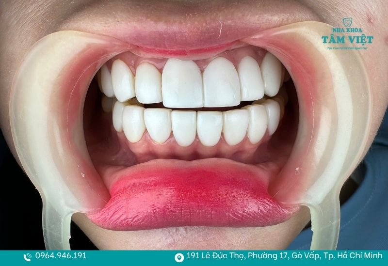 Việc bọc răng sứ giúp bạn nhai thức ăn hiệu quả hơn